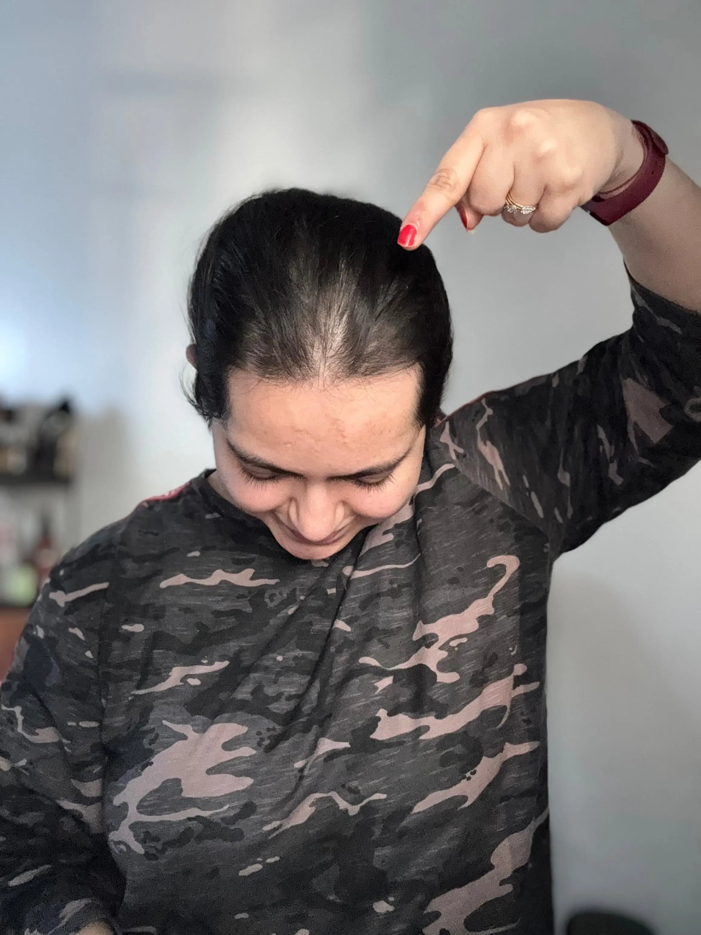 Front Hairline Topper For Receding Hairline | Presh Beauti